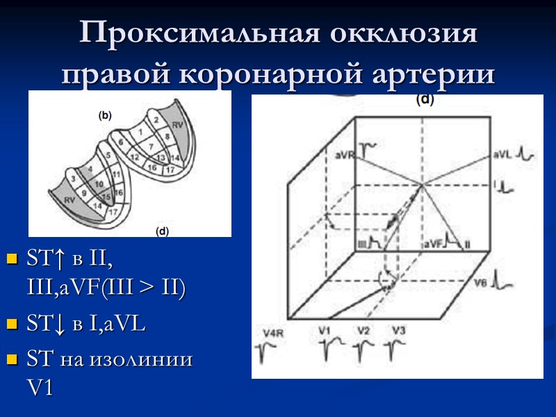 Проксимальная окклюзия правой коронарной артерии ST↑ в II, III,aVF(III > II) ST↓ в I,aVL